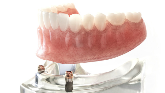 インプラントオーバーデンチャーの特徴と費用金額 - 北九州市【入れ歯
