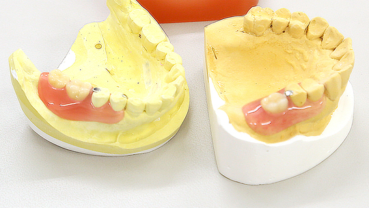 ノンクラスプデンチャー（義歯）の費用・金額 - 北九州市【入れ歯専門
